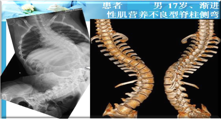 上海數(shù)造攜手安徽省二院骨三科專家章玉冰主任 開展3D打印醫(yī)療骨科應用在線講堂